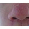 酒渣鼻的常见症状主要有哪些呢