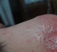 酒糟鼻需要怎么护理呢