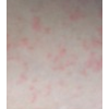 诱发湿疹有哪几点原因呢