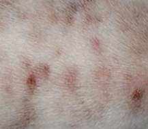 生活中我们应该注意湿疹的哪些危害呢
