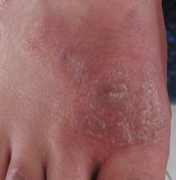 糜烂型脚气的治疗方法盘点 预防脚气发生时关键