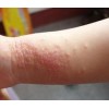 小儿丘疹性肢端皮炎诊断的方法有什么?