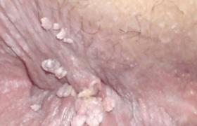 女性尖锐湿疣治疗注意事项