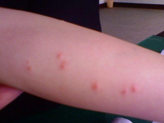 秋季警惕虫咬性荨麻疹