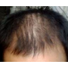 脂溢性脱发的典型症状是什么啊