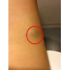 预防脂肪瘤心情很重要