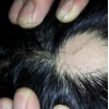 斑秃好转的症状介绍 生活中要做头发护理