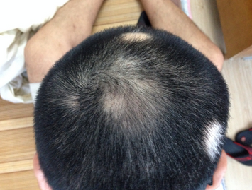 斑秃的原因及治疗