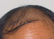 脱发给患者造成的危害有哪些