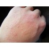 手部干燥性湿疹该怎样预防