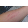 鱼刺伤可能引起皮肤过敏