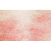 为什么会产生干性湿疹，如何避免