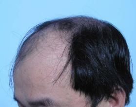 脂溢性脱发是什么原因