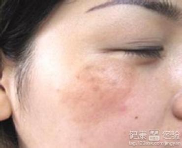 哪些食物能减淡黄褐斑呢