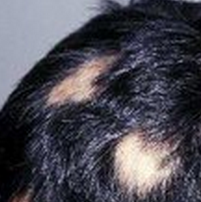 斑秃吃什么药 3种治疗方法快速恢复病情