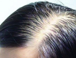 脱发的预防注意事项有哪些