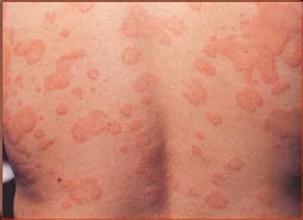 预防接触性荨麻疹注意远离过敏原