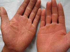 手癣的种类与治疗方法