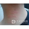 脂溢性皮炎常见症状有哪些
