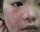 宝宝胎记的危害