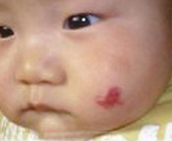 新生儿胎记该怎样去除