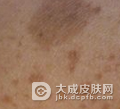 日常可以预防咖啡斑吗