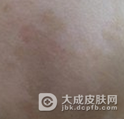 咖啡斑治疗后怎么护理