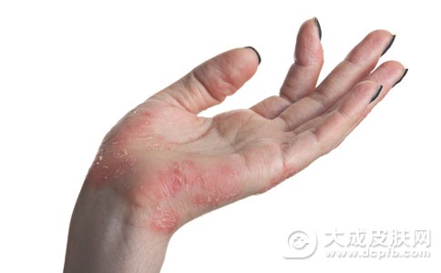 湿疹症状有哪些 真菌性湿疹怎么治