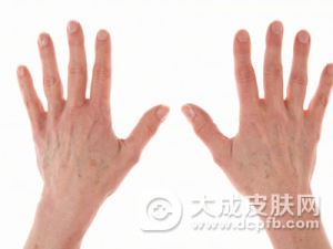 成人得湿疹怎么办 养成良好的饮食习惯很重要