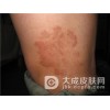 患有体癣吃什么好