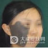 太田痣是如何产生的