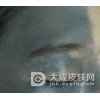 要怎么治疗太田痣?