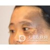 太田痣的分型治疗