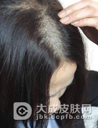 生活中一定要做预防斑秃