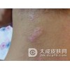 患上过敏性皮炎日常生活要注意些什么