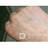 过敏性皮炎的症状特点是什么