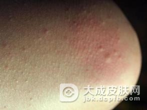 过敏性皮炎会产生什么样的危害