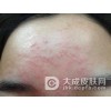 青春痘可以分为哪几类