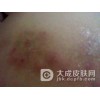 体癣都有哪些分类