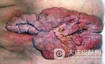 患上了淋病对生育的影响是什么