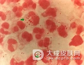 男性在治疗淋病期间要注意什么