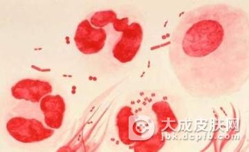 女性淋病的症状表现有哪些