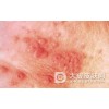非淋治疗时的常见注意事项