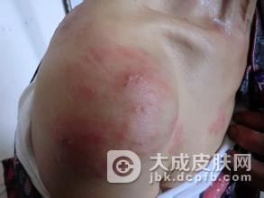 带状疱疹患者饮食方面有什么值得注意