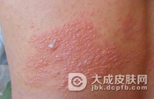 小儿患带状疱疹的症状有哪些