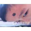 复发太田痣怎么治?
