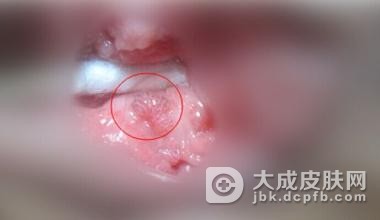 女性尖锐湿疣带来哪些影响