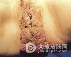 未婚女性为什么也会患尖锐湿疣