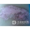 白癜风的皮损颜色有哪些