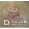 头癣有什么不能吃的东西吗